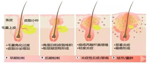 痤疮发生机制